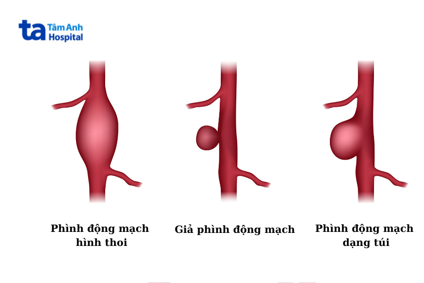 một số loại phình động mạch