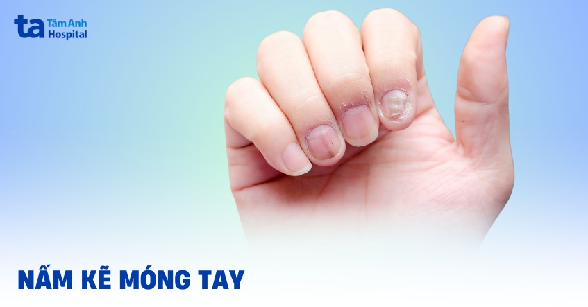 Nấm kẽ móng tay: Nguyên nhân, dấu hiệu, cách chữa trị, phòng ngừa