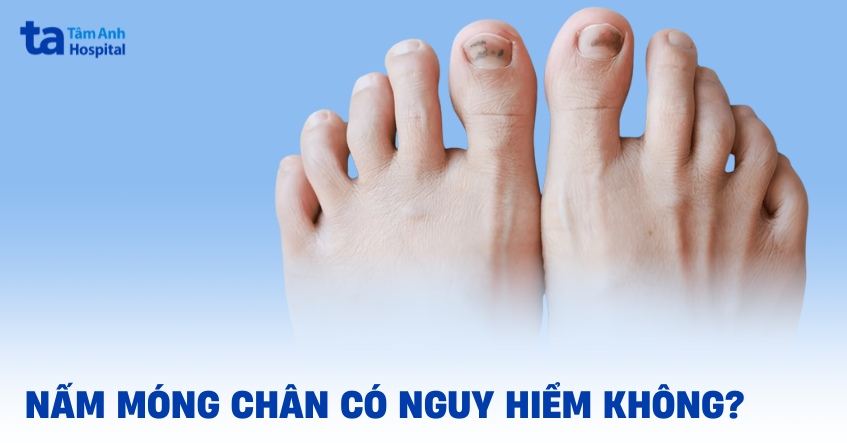 Nấm móng chân có nguy hiểm không? 6 biến chứng tiềm ẩn