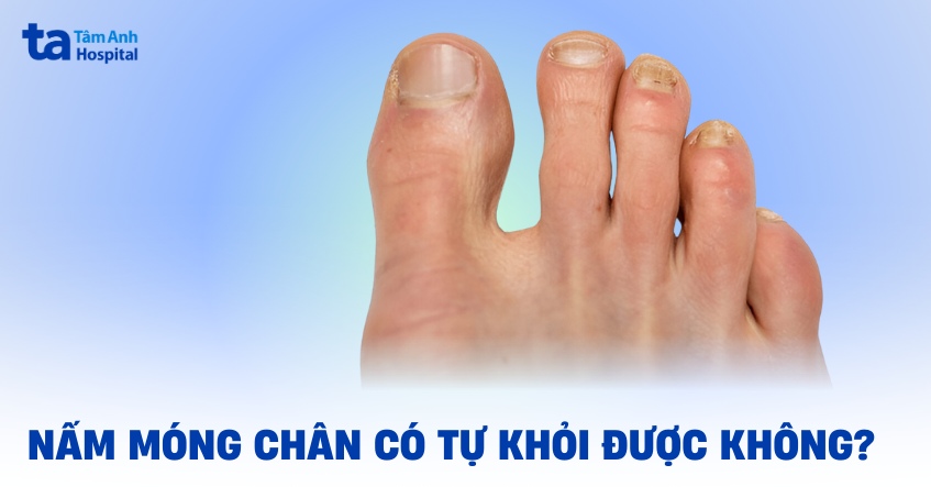 nấm móng chân có tự khỏi được không