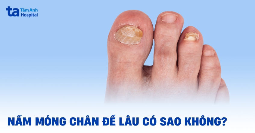 Nấm móng chân để lâu có sao không? 6 tác hại khôn lường cần lưu ý