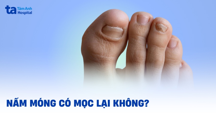 Bị nấm móng có mọc lại không? Yếu tố nào ảnh hưởng thời gian?