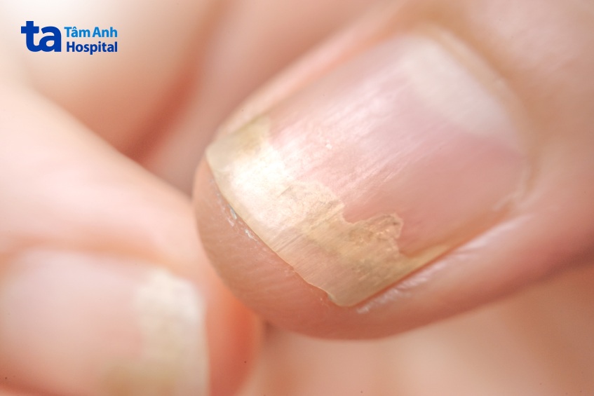 nấm móng tay có ảnh hưởng tới tính mạng không