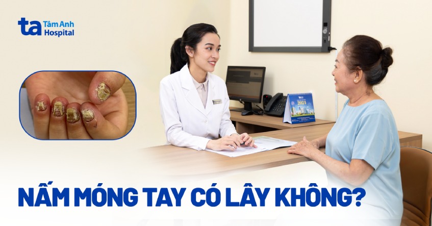 Bệnh nấm móng tay có lây không? Lây qua đường nào phổ biến?