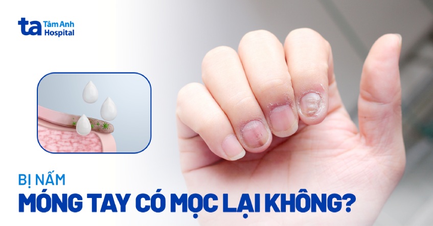 Bị nấm móng tay có mọc lại không? Yếu tố nào ảnh hưởng?