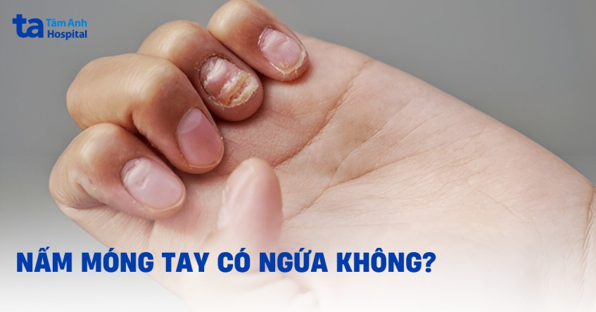 Nấm móng tay có ngứa không? Có gây đau rát không?
