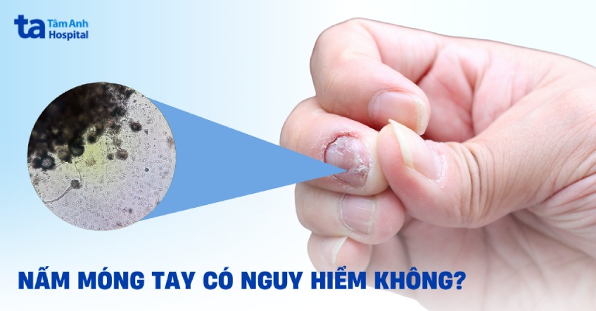 Nấm móng tay có nguy hiểm không? Có ảnh hưởng tính mạng?