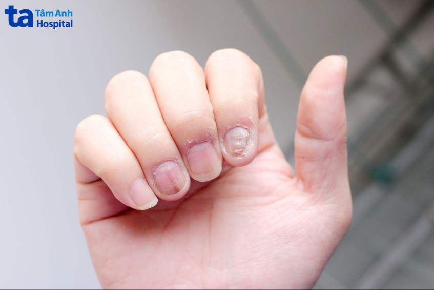 nấm móng tay khó điều trị dứt điểm do nhiều nguyên nhân