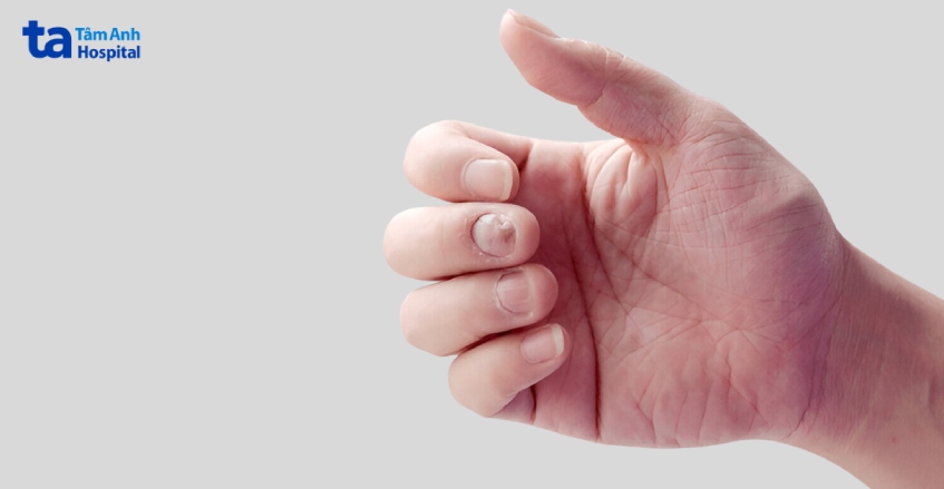 nấm móng tay ở giai đoạn nào triệu chứng rõ nhất