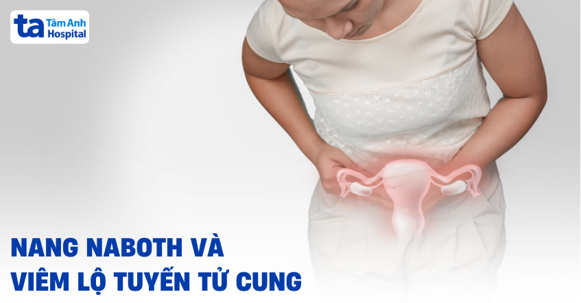 Nang naboth và viêm lộ tuyến có giống nhau không? Mối quan hệ là gì?