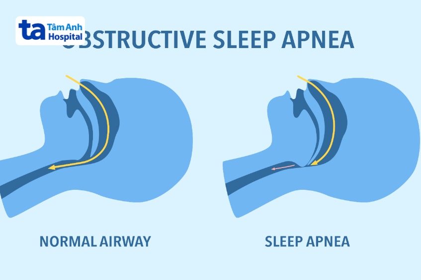 ngưng thở khi ngủ có thể đe dọa tính mạng