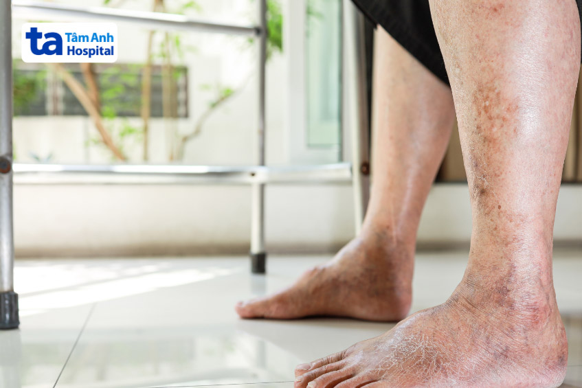 Người bị bệnh tim uống quá nhiều nước có thể khiến tình trạng phù nặng hơn