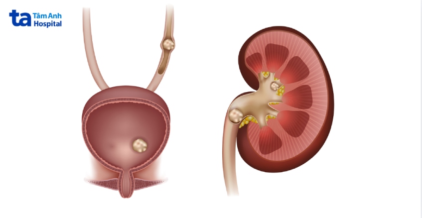 nguyên nhân dẫn đến tình trạng sỏi niệu quản 1_3 dưới