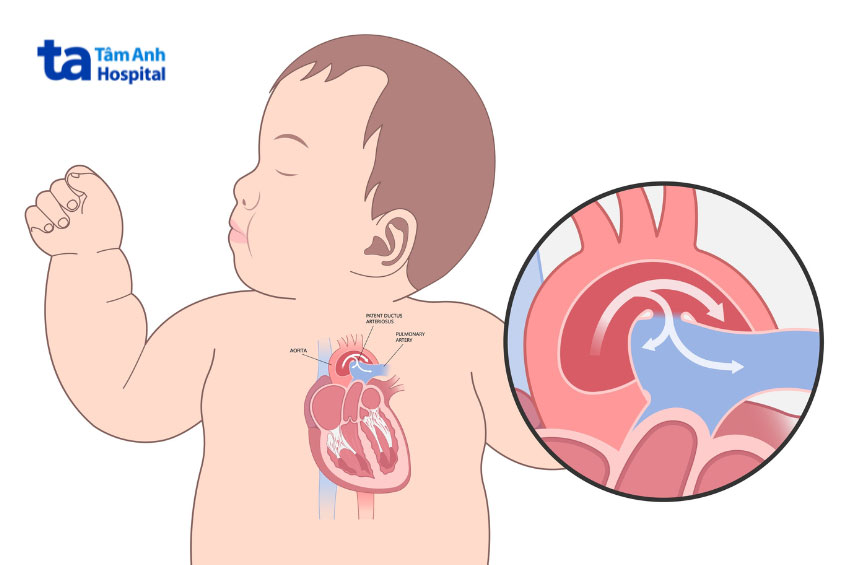 nguyên nhân do bệnh tim bẩm sinh gây ra