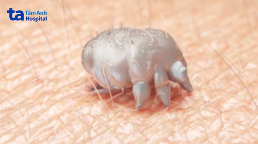 nguyên nhân gây ghẻ da đầu