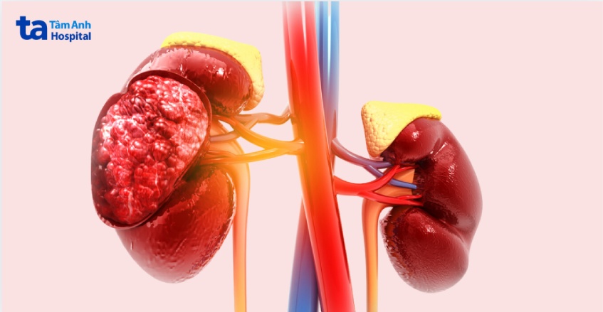 nguyên nhân gây hội chứng thận hư nguyên phát