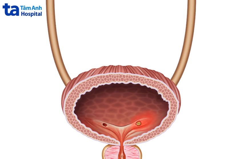 nguyên nhân gây sỏi bàng quang là sự kết tự từ các chất thải