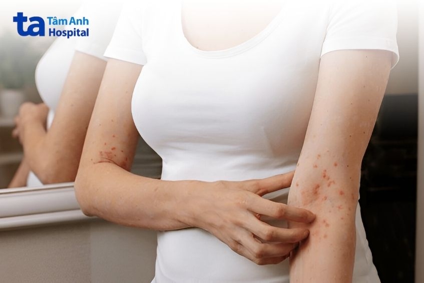 nguyên nhân ghẻ phỏng để lại sẹo