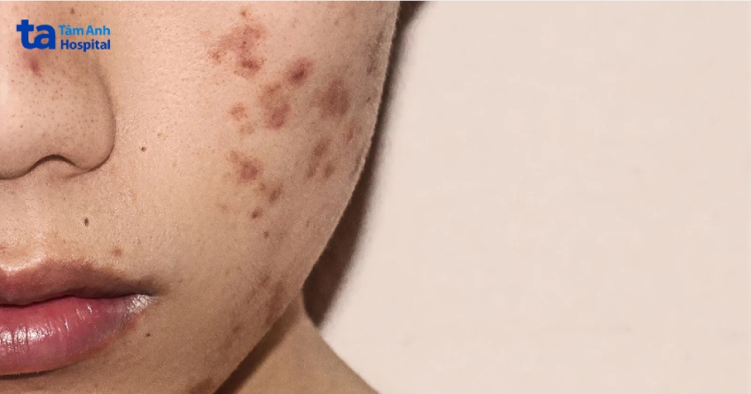 nguyên nhân hình thành sẹo mụn