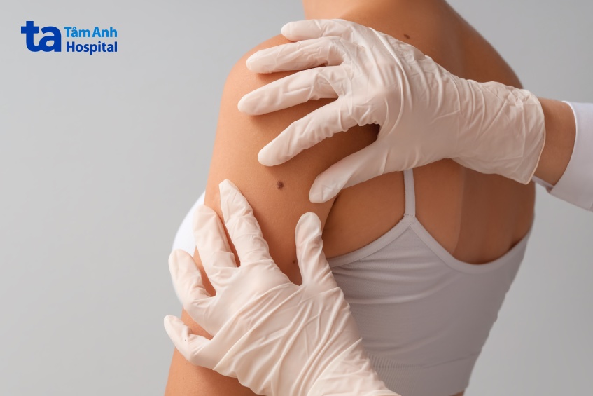 nhiều nốt ruồi nguy cơ ung thư da cao