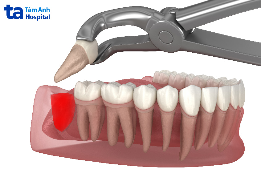 nhổ răng chảy máu bao lâu