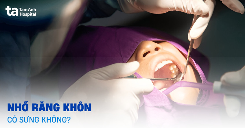 Nhổ răng khôn có sưng không? Mất bao lâu để hồi phục hoàn toàn?