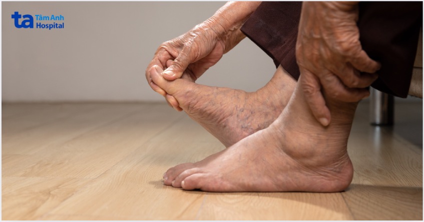 nhược điểm khi kích thích thần kinh chày