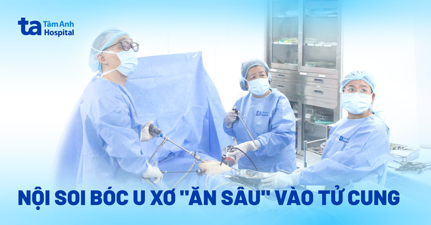 nội soi bóc u xơ ăn sâu vào tử cung