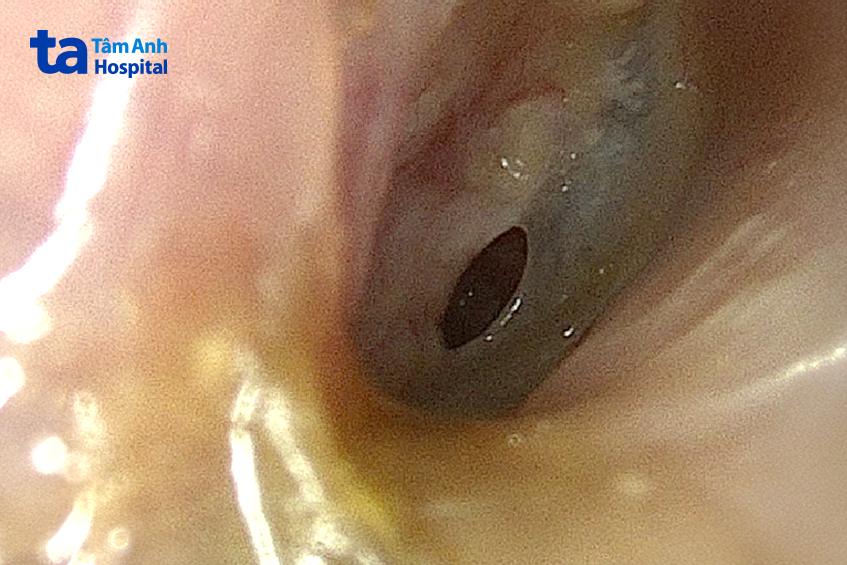 nội soi màng nhĩ bị thủng