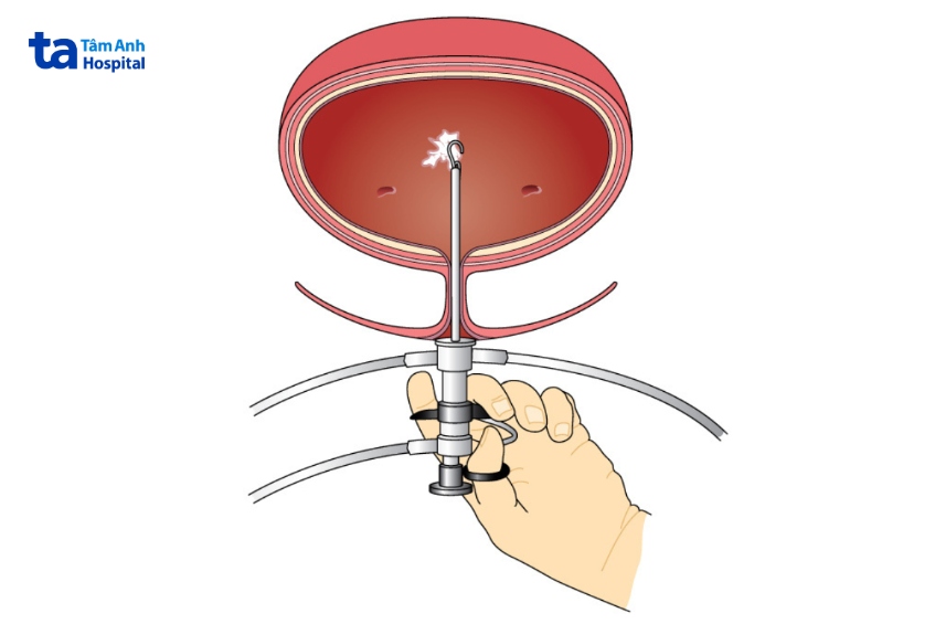 nội soi sinh thiết tế bào ung thư bàng quang