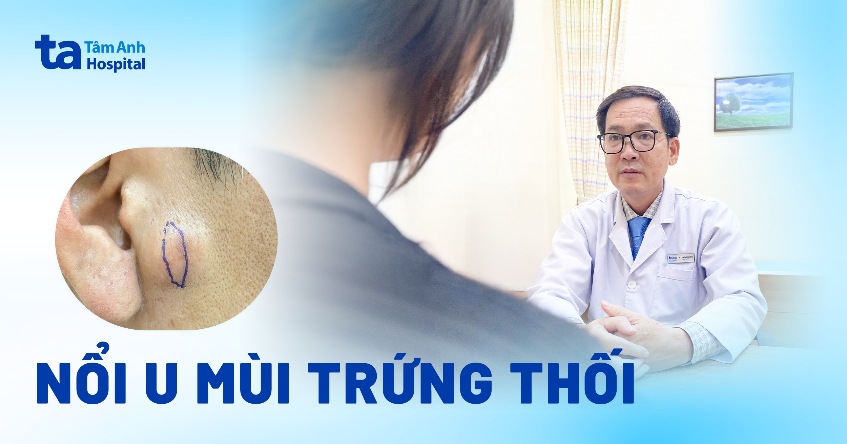 nổi u mùi trứng thối