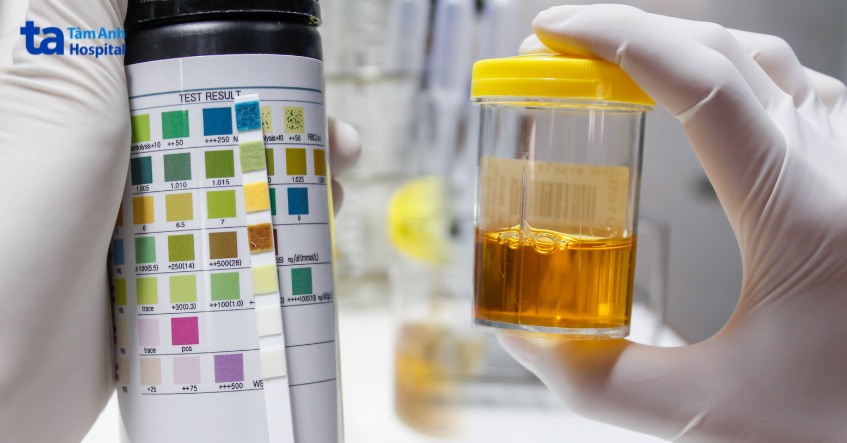 nước tiểu có màu vàng đậm