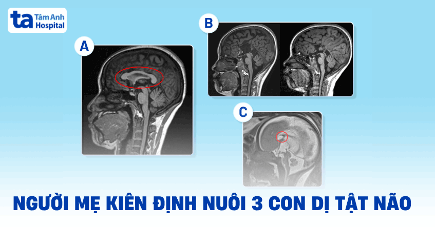 Người mẹ kiên định nuôi 3 con dị tật não