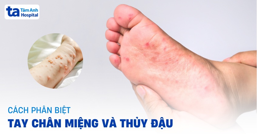 Cách phân biệt tay chân miệng và thủy đậu nên biết để so sánh