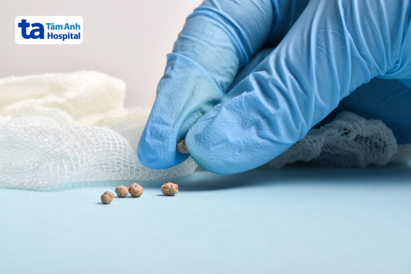 phẫu thuật cắt túi mật mọc lại không