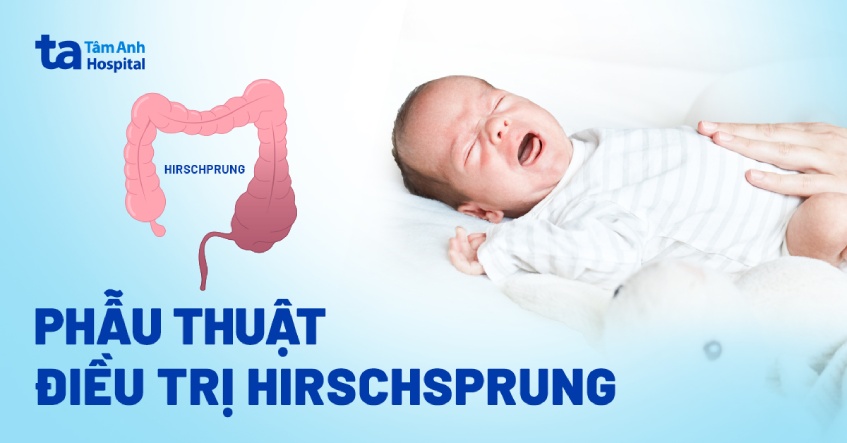Phẫu thuật điều trị Hirschsprung: Phương pháp và quy trình mổ