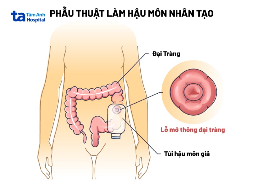 phẫu thuật tạo hậu môn nhân tạo cho trẻ