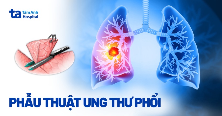 4 phương pháp phẫu thuật ung thư phổi hiện đại, hiệu quả