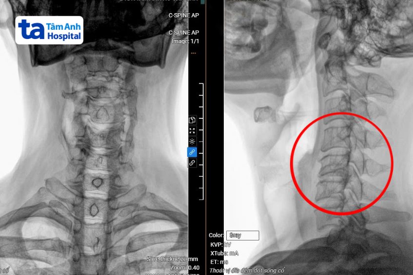phim chụp mri hiển thị đốt sống cổ thoát vị