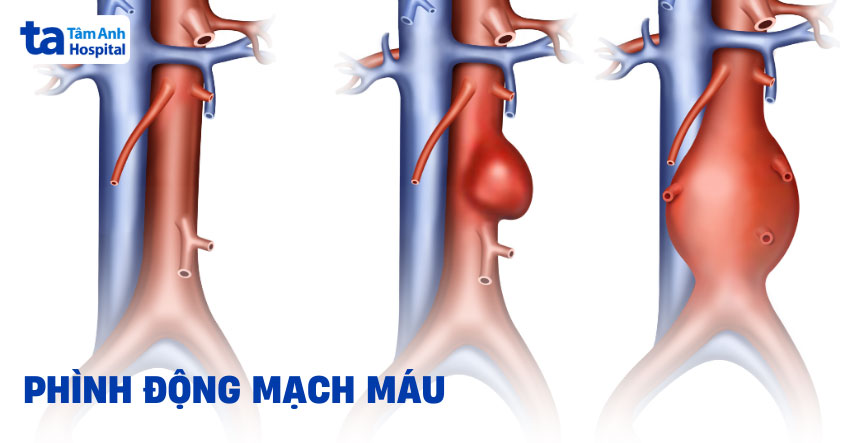 Phình động mạch: Nguyên nhân, dấu hiệu, chẩn đoán, phòng ngừa