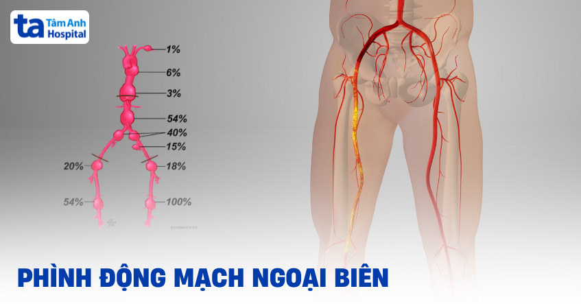 phình động mạch ngoại yên