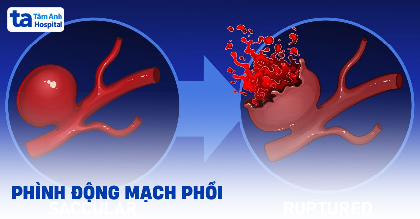 Phình động mạch phổi có nguy hiểm không? Nguyên nhân, dấu hiệu