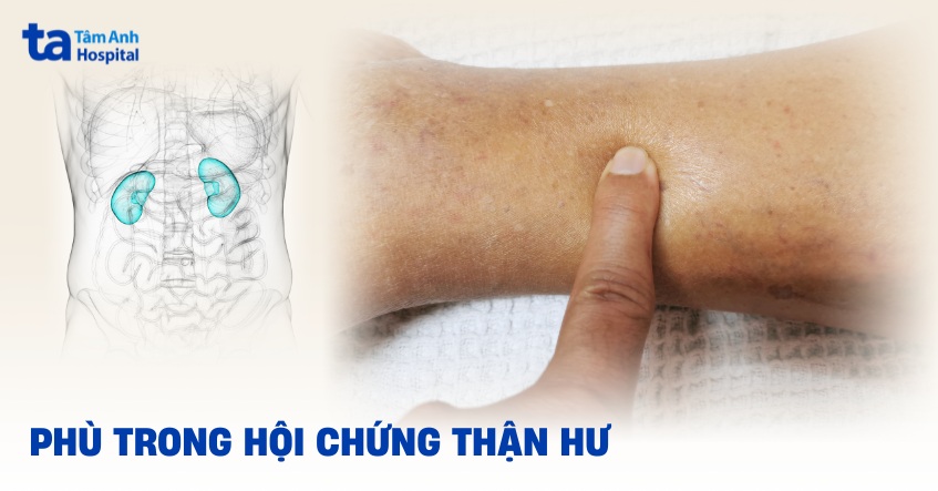 Phù trong hội chứng thận hư: Cơ chế, đặc điểm và cách điều trị