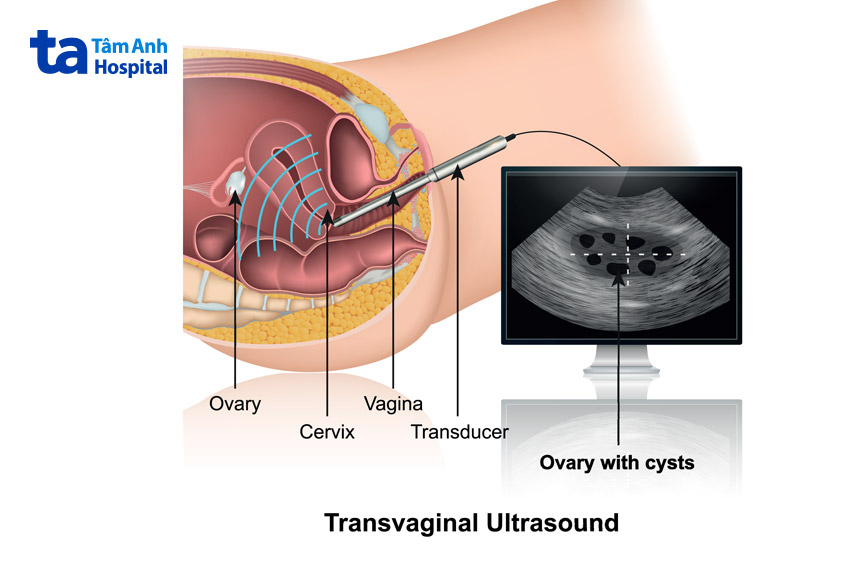Quá trình siêu âm lạc nội mạc tử cung kéo dài từ 30 phút đến một giờ