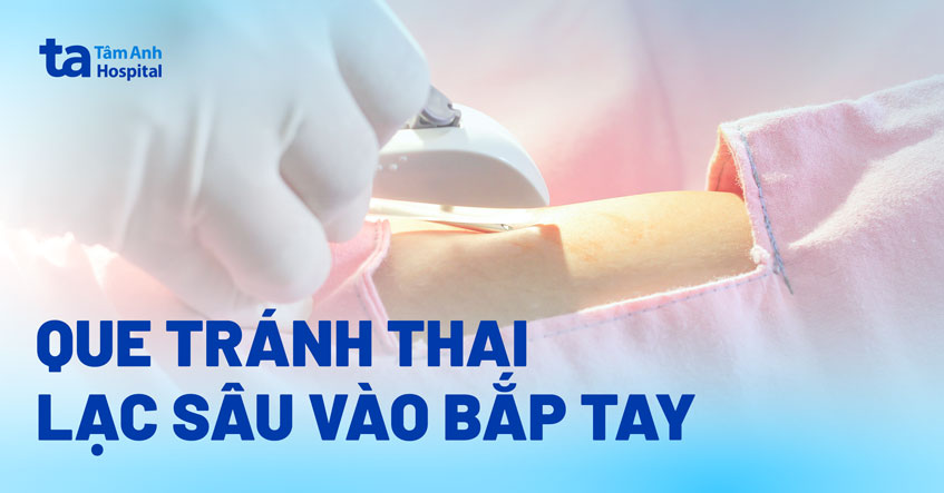 Que tránh thai lạc sâu vào bắp tay