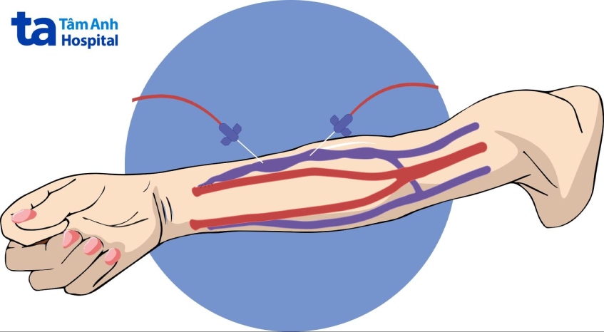 quy trình chạy thận nhân tạo chu kỳ