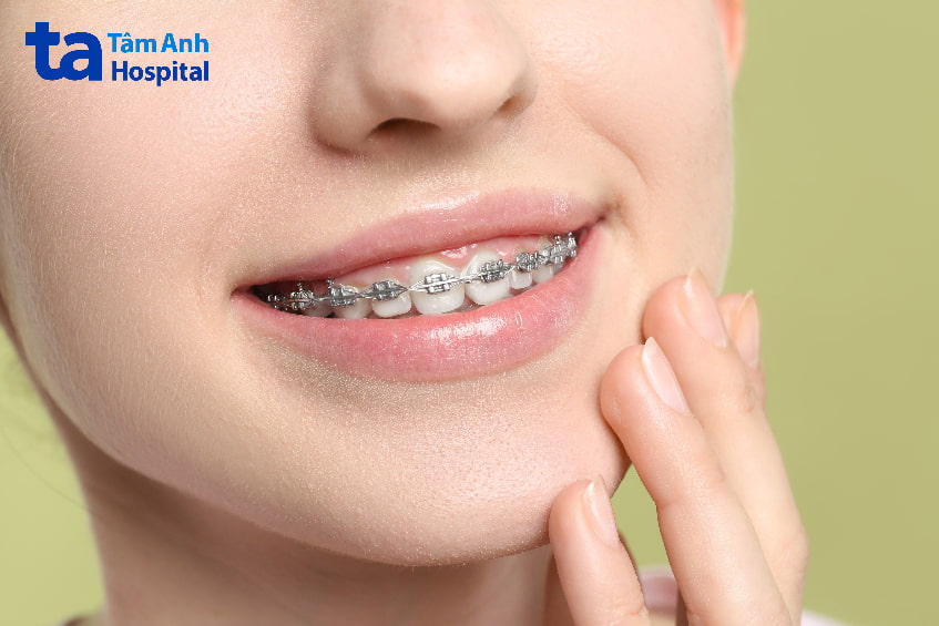Phương pháp điều trị khớp cắn sâu
