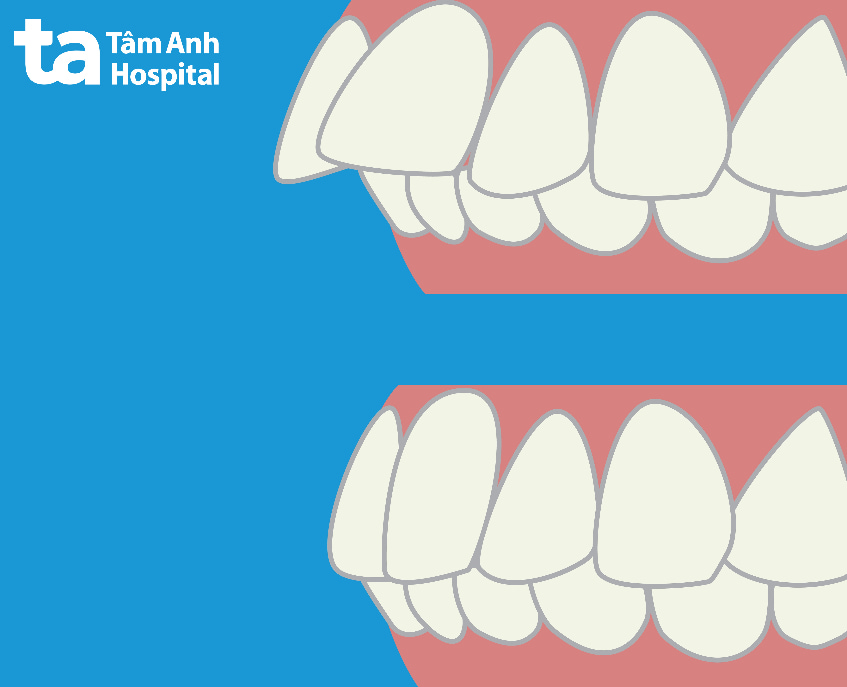 Dấu hiệu nhận biết khớp cắn sâu