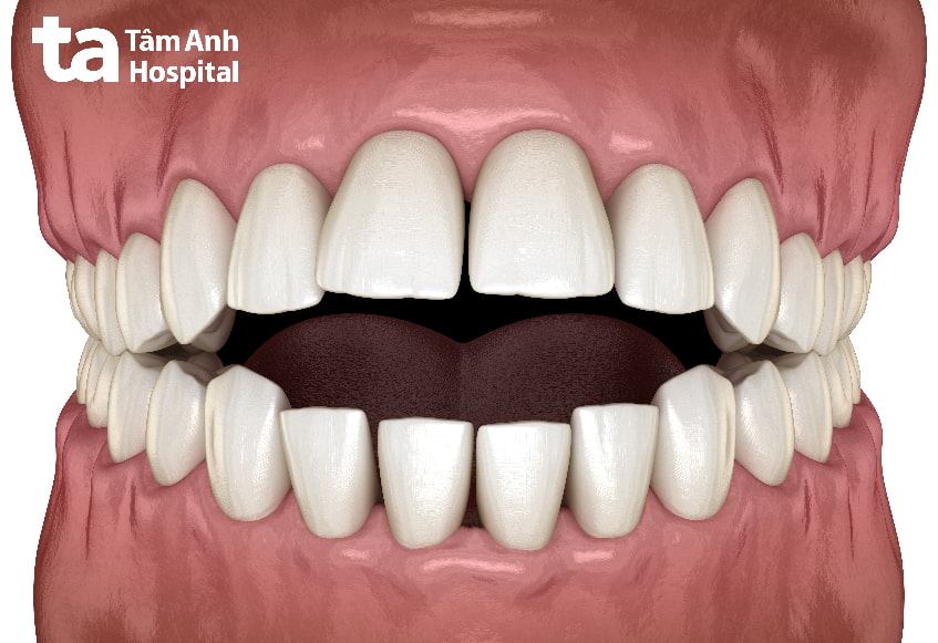 Dấu hiệu sai khớp cắn