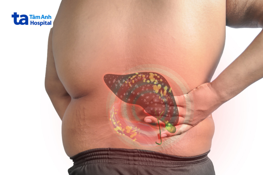 Những yếu tố làm tăng nguy cơ tổn thương gan khi sử dụng bia rượu